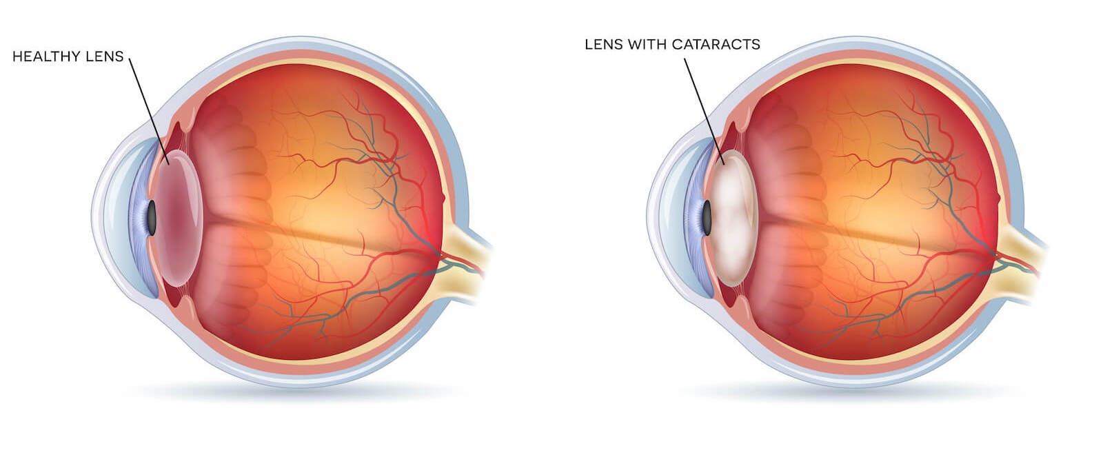 Post Op Recovery After Cataract Surgery