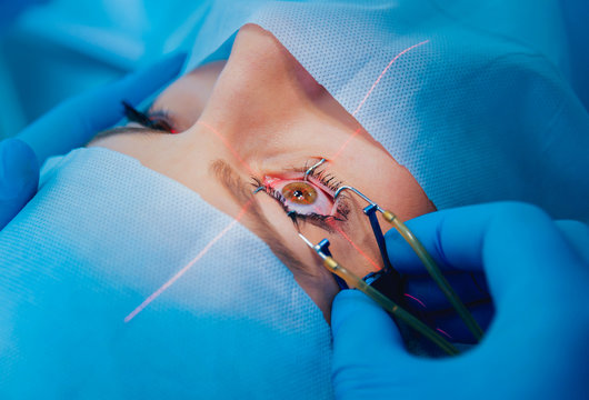 Micro Phaco Cataract Surgery